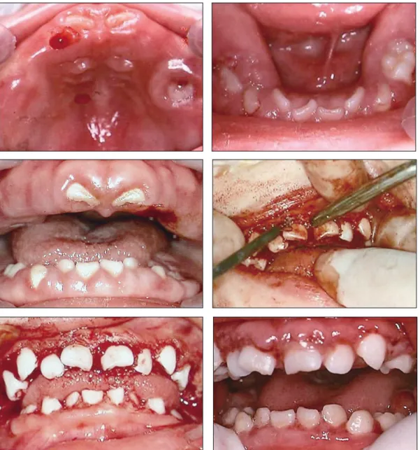 Fig. 2. Intraoral photos before, during, after 2nd electrosurgery and 5 days later. (Age: 2 year 11 months)