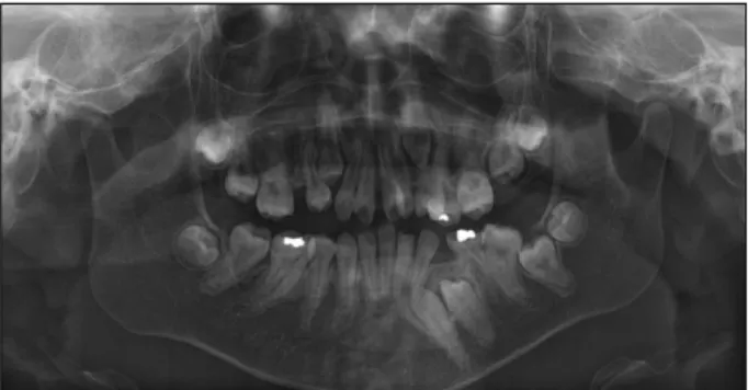 Fig. 6. Panoramic radiograph. (Age: 14 years 4 months) The mandibular left second primary molar was extracted.
