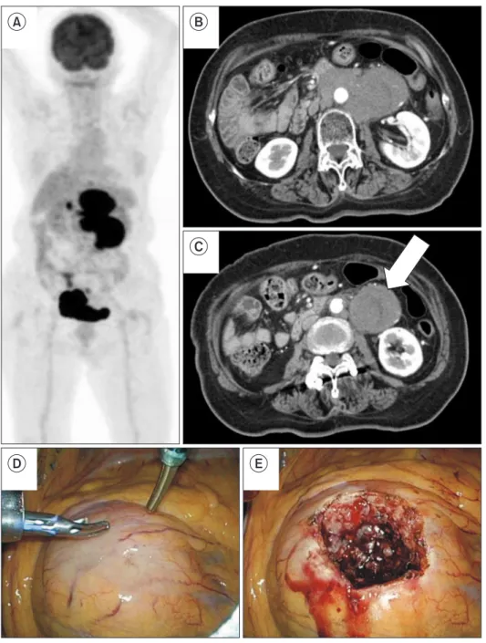 Fig. 2. During evaluation for abdominal  pain, a 76-year-old female patient was  found to have enlarged paraaortic and  mesenteric lymph nodes