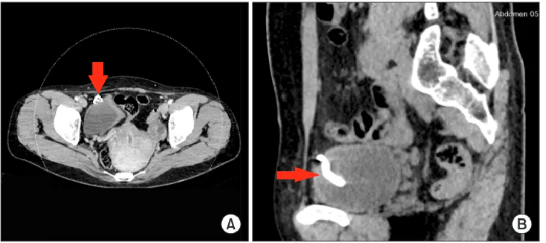 Fig. 1. Abdominal computed tomography  (A: horizontal section. B: sagittal section)  indicating a T-shaped intrauterine device  embedded in the bladder wall (red arrow).