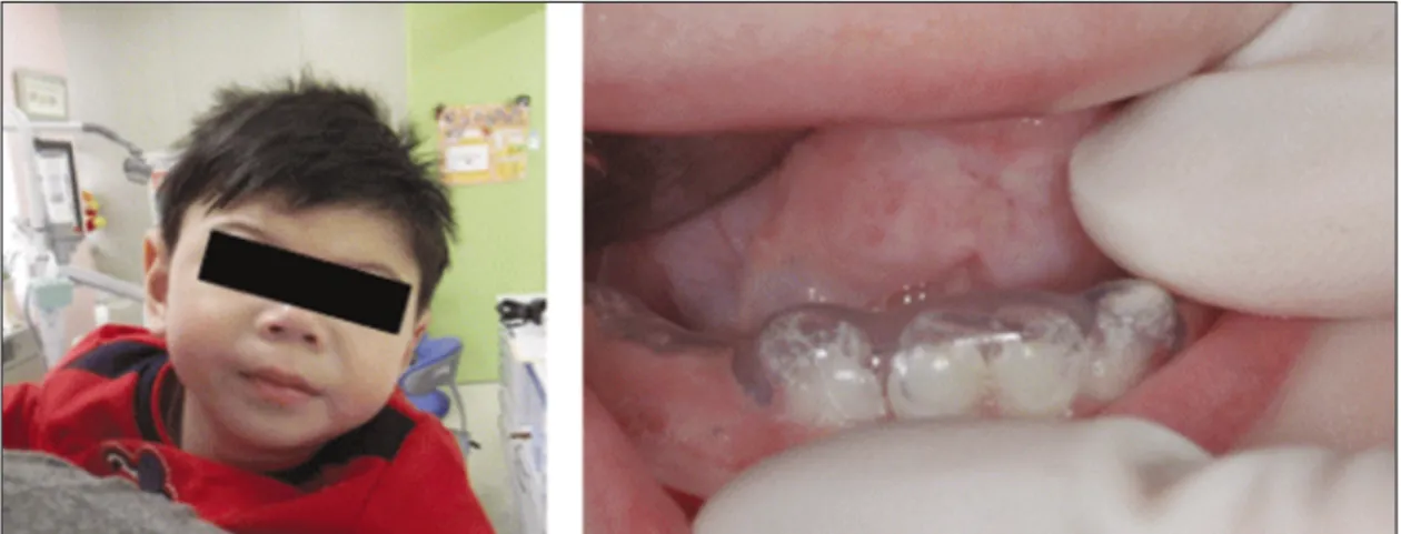 Fig. 5. Three-week follow-up after tongue protector delivery.