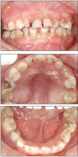 Fig. 2. Intraoral  photo  after  caries  treatment  under  general anesthesia. (Age: 7 years and 1 month)