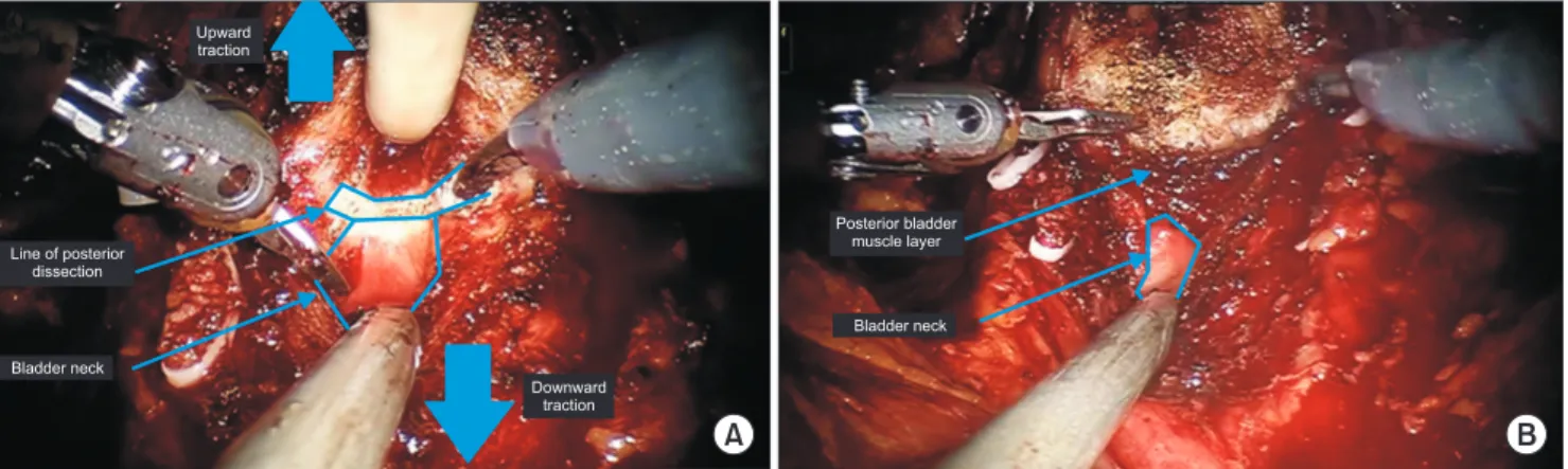 Fig. 4. (A) Upward traction of the prostate by holding the Foley catheter tip (upward large blue arrow) and down ward traction of the bladder  neck by the tip of suction devise (downward large blue arrow) with cauterization marking of the line posterior di