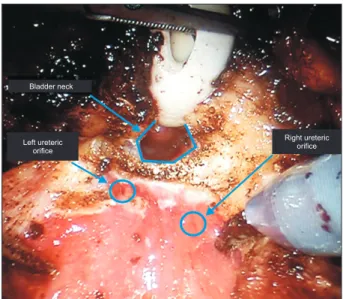 Fig. 7. Bladder neck dissection during robot-assisted radical prostatec- prostatec-tomy in patient with previous transurethral resection of the prostate  dem-onstrating the proximity of left ureteric orifice to the bladder neck.