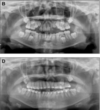Fig. 1. Panoramic  view  before  &amp;  after  secondary  bone  graft with Bio-Oss � in Case 1.