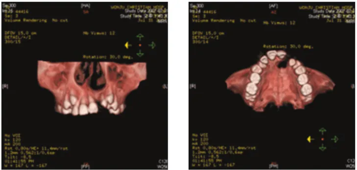 Fig. 2. Computed tomography of  alveolar bone defect in Case 1 patient.
