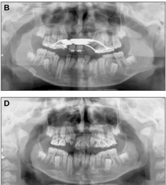 Fig. 4. Panoramic  view  before  &amp;  after  secondary  bone  graft with Bio-Oss � in Case 2.