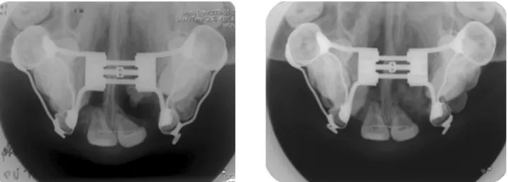 Fig. 6. Occlusal radiographs before &amp; after secondary bone graft in Case 3 patient.