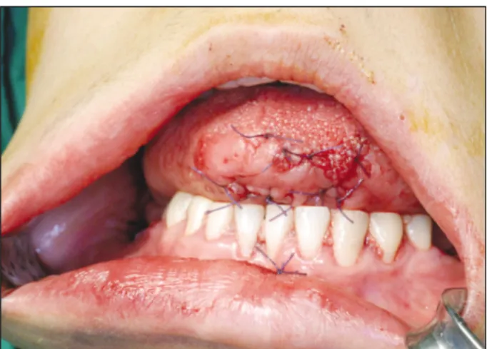 Table 1. Tongue lacerations that require repair 13) Disecting wounds