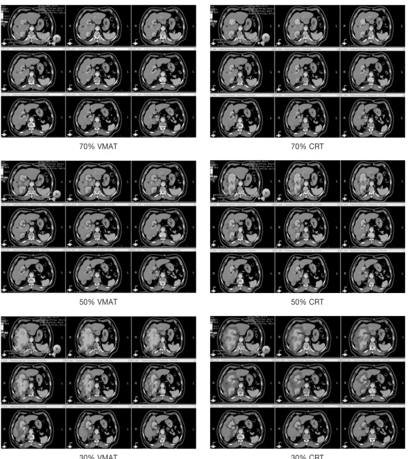 Fig 2. The comparison of isodose distribution in VMAT and CRT for two targets case