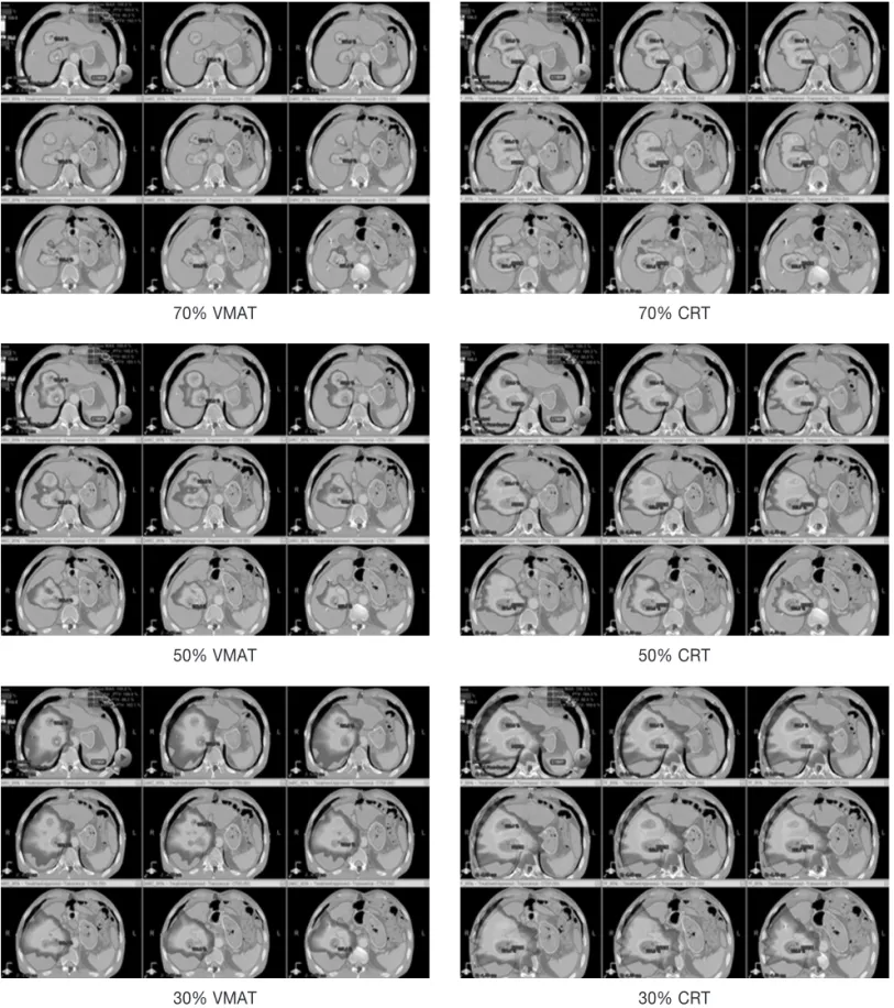 Fig 3. The comparison of isodose distribution in VMAT and CRT for three targets case : VMAT achieved better conformality to the 70% and 50% isodose distribution of the PTV and better spinal cord and stomach sparing to the 30% isodose distribution as compar