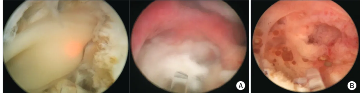 Fig. 1. Intraoperative images. (A) As the abscess cavity was opened up, the pus was drained from the cavity