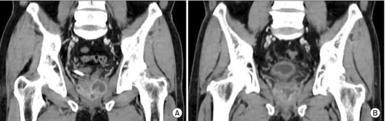 Fig. 2. Preoperative and postoperative computed tomography (CT) scans of a patient. (A) Preoperative CT scan showing multiloculated prostatic abscess- abscess-es