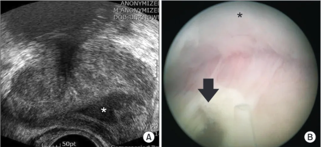 Fig. 3. Transrectal ultrasound (TRUS) im- im-age and intraoperative imim-age. (A) TRUS  image showing that the abscess cavity  (asterisk) is located between the prostate  adenoma and the prostate capsule
