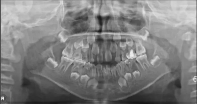 Fig. 1. Initial panoramic radiograph.