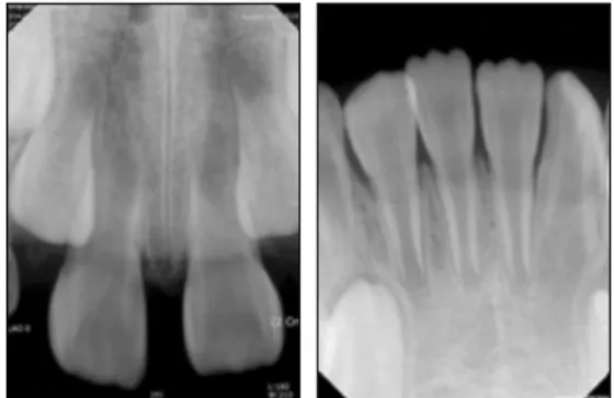 Fig. 5. Mother’s panoramic radiograph. Fig. 6. Permanent teeth.