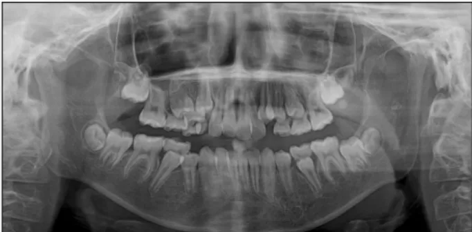 Fig. 4. CT view of the patient. Both curvilinear gyral calcifications and stromal atrophy of the cortex on the left parietal and  occipi-tal lobe were seen.