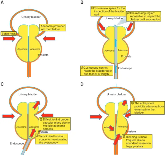 Fig. 1. Technical challenges in enucleation of an extremely large prostate. (A) The enlarged adenomas frequently protrude into the urethral  lumen; therefore, a bottleneck is commonly formed at the bladder neck level, and intravesical prostatic protrusion 