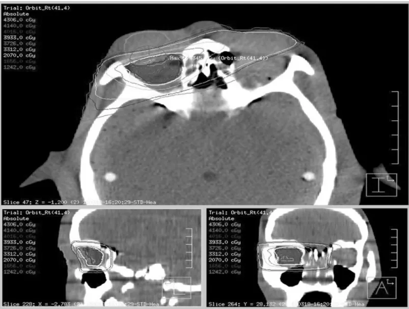 Fig 3. IMRT plan image of the human phantom      