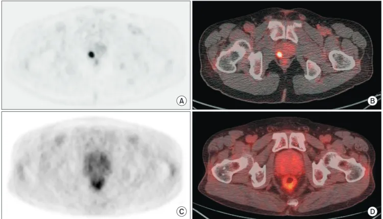 Fig. 2. Axial views of FDG uptake by the prostate. (A) Diffusion-weighted image showing focal uptake