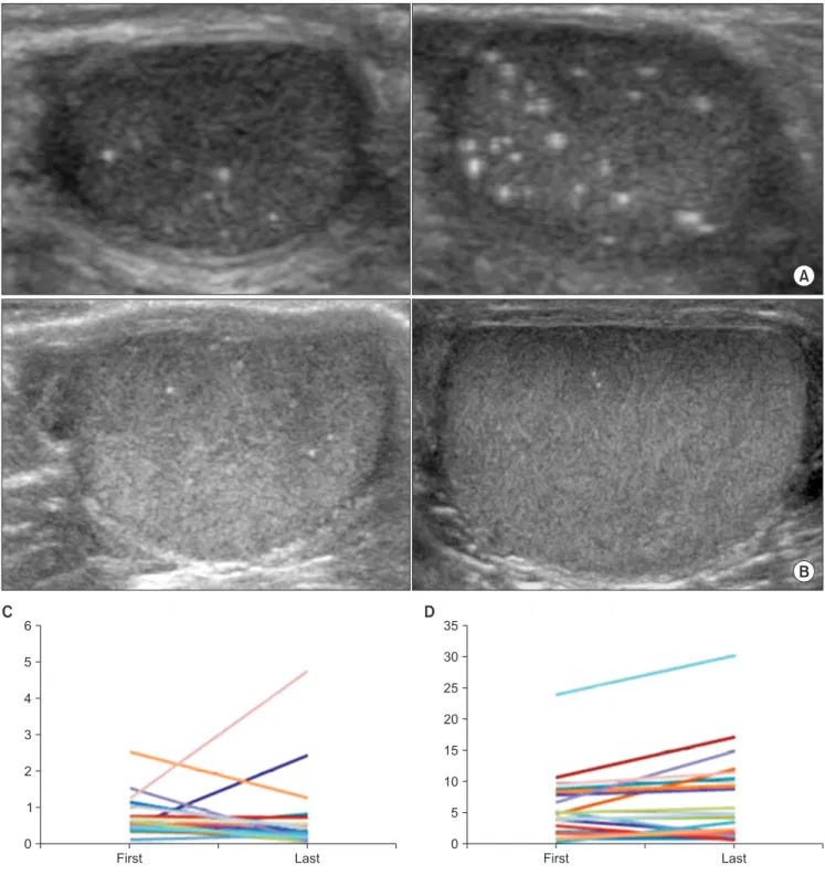 Fig. 3. Change of calcific density demonstrated by the ultrasound image ([A] increase in diffuse type group and [B] decrease in focal type group)  and by the bar graph (focal type [C] and diffuse type [D]).