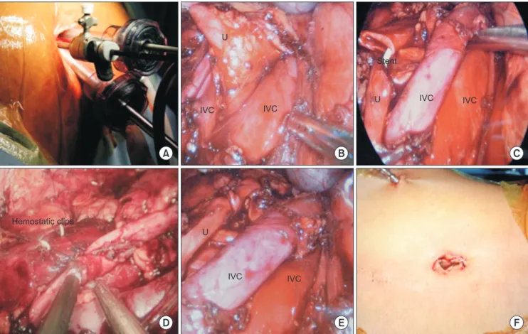 Fig. 2. (A) Port placement in SIMPLE technique. (B) Intraoperative image showing ureter with periureteric tissue being mobilized between the  right double inferior vena cava