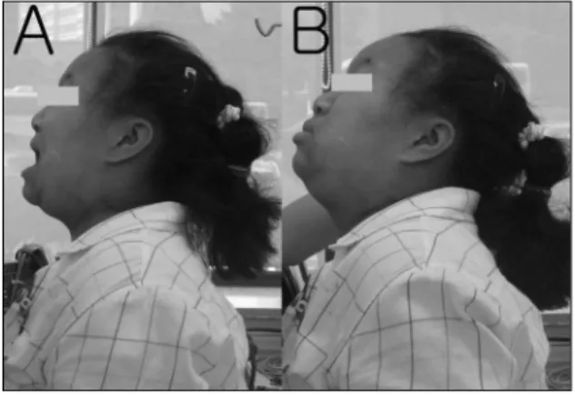 Fig. 2.  A #3 laryngeal mask airway (LMA) was inserted immediately, which allowed us to ventilate her lungs and restore the oxygen saturation.