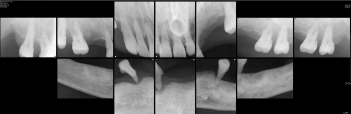 Fig. 1.  Since  we  could  not  take  panoramic  radiograph,  full  mouth  standardized  intra  oral  film  was  taken  under  general anesthesia and some hopeless teeth extraction was done.