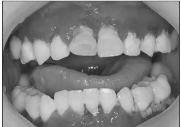 Fig. 5.  Generalized alveolar bone loss. Fig. 6.  Gingiva during oral hygiene instruction.