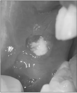 Fig. 7.  Buccal mucosal ulceration.