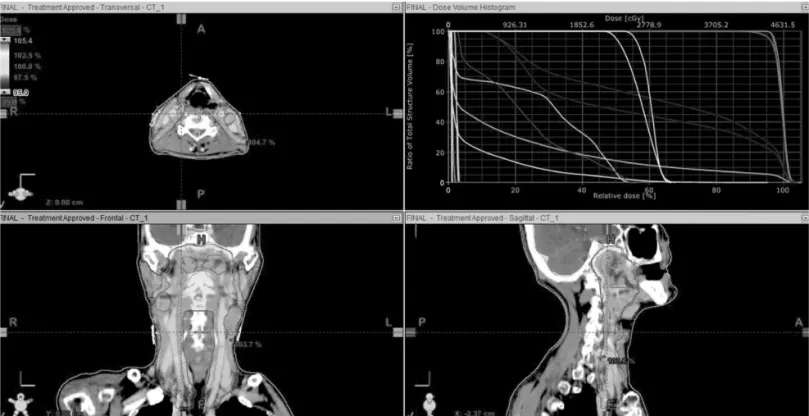 Fig 1. The plan have 0.1513 mm leaf gap in Head and Neck IMRT plan.