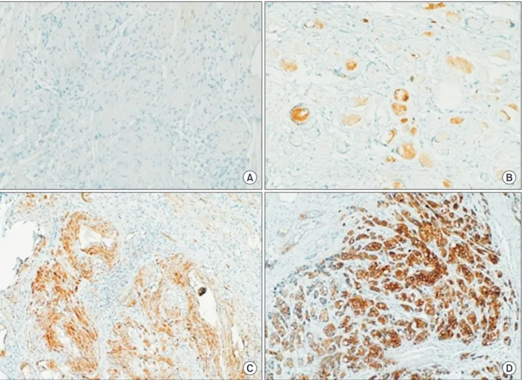 Fig. 1. HSP27expression in prostate tissues (immunohistochemical stain, ×100). (A) HSP27 negative, 0; (B) HSP27&lt;5%, +1; (C) HSP27 5%–50%, +2; 