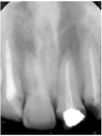Fig. 1.  A. 치료전 치근단 방사선 사진.
