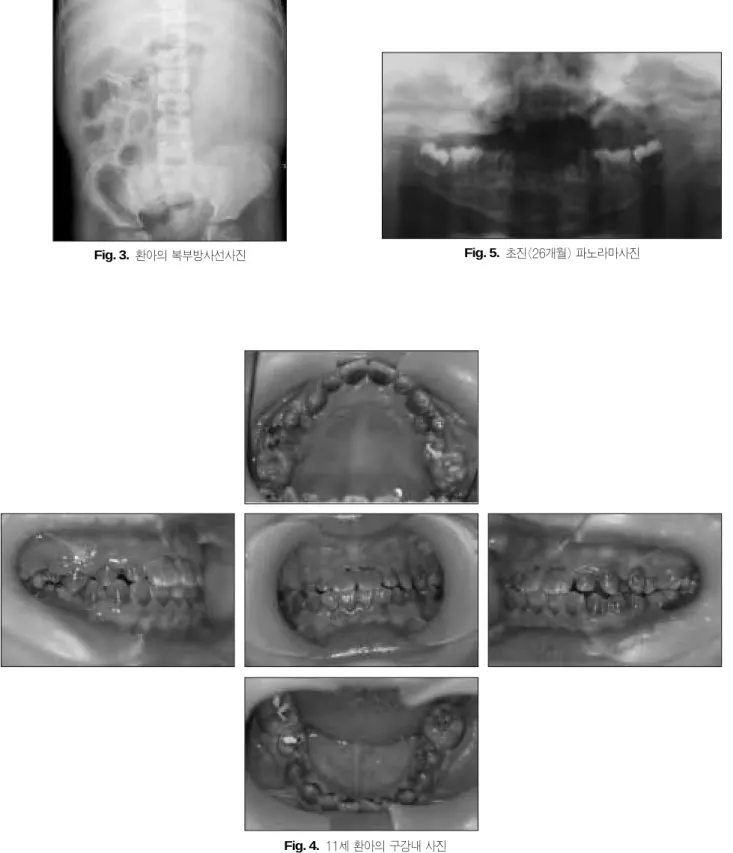 Fig. 4.  11세 환아의 구강내 사진