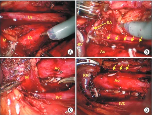 Fig. 3. Images from robot-assisted laparo- laparo-scopic retroperitoneal lymph node  dissec-tion