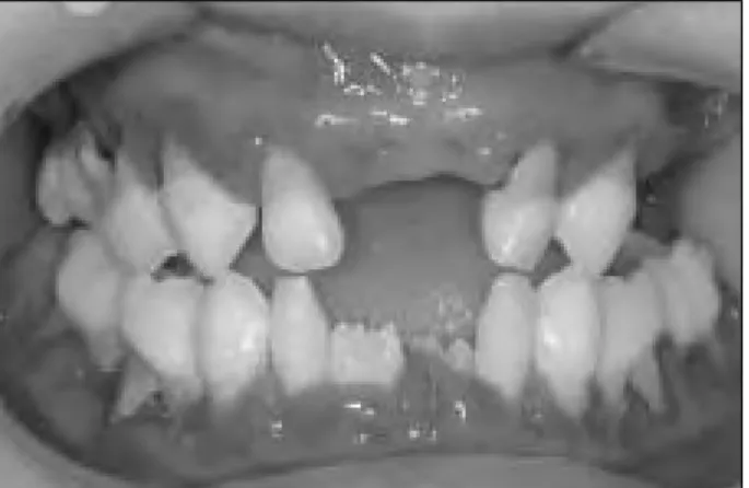 Fig. 1.  Initial intraoral photograph(5yr 3mo).