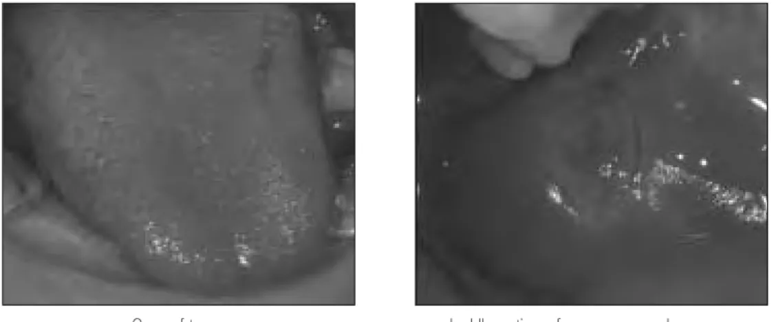 Fig. 6.  Lateral cephalometric view(6yr 6mo).