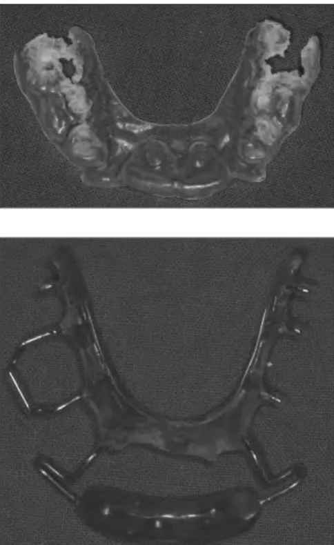 Fig. 1. Initial photo.  Fig. 2. The previous oral appliance.