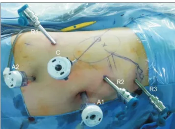 Fig. 1. The placement and location of trocars in our four arm approach  robot-assisted laparoscopic partial nephrectomy (right side)