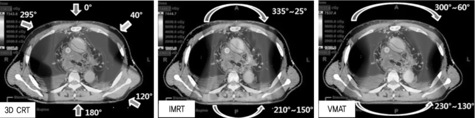 Fig 1. 3D CRT, IMRT and VMAT Plans using restricted angle.