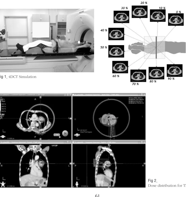 Fig 1. 4DCT Simulation