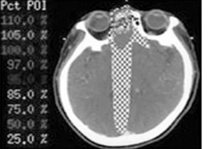 Fig 2. Intensity Modulated Radiation Therapy