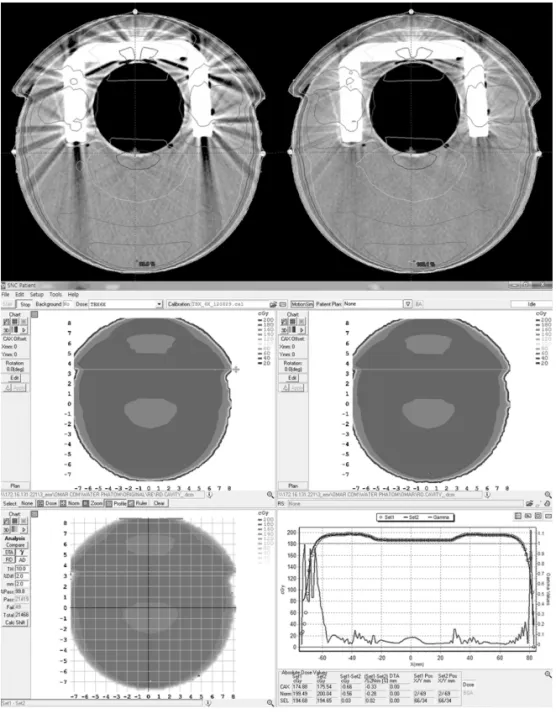 Fig  1.  Gamma  passing  rate  of  dose distribution  between  head&amp;neck phantom CT with dental artifact.