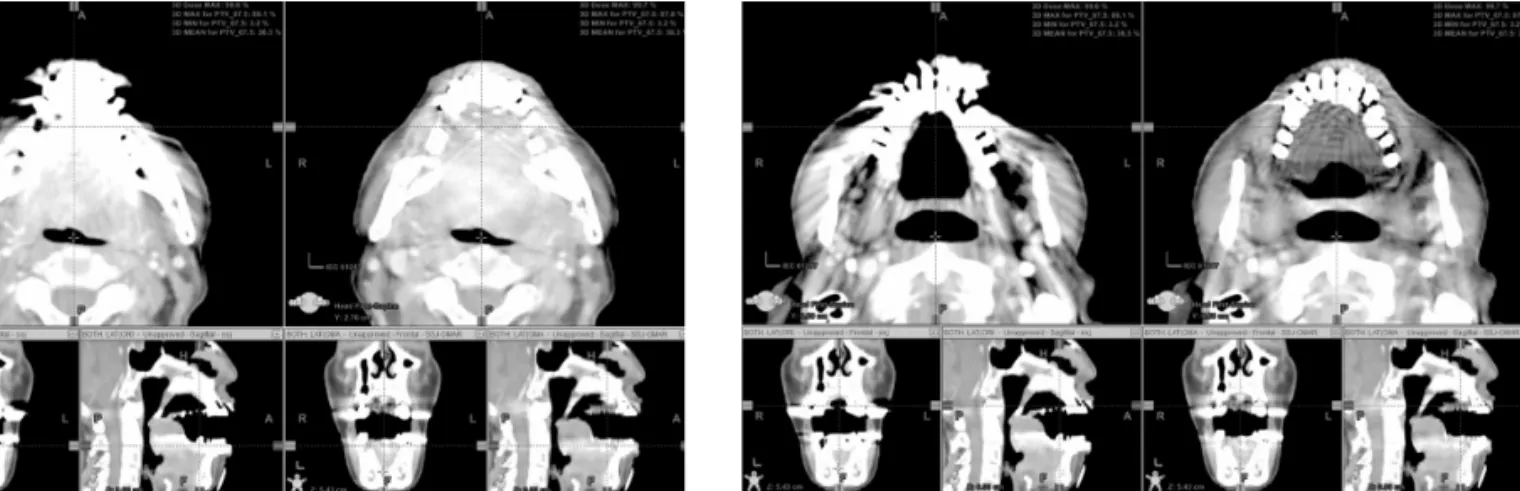Fig 3. A case of well corrected artifact in O-MAR CT. Fig 4. Cavity filled higher HU in O-MAR CT than original CT.