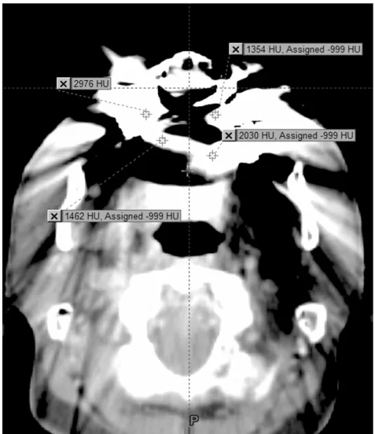 Fig 5. Metal artifact in air cavity.