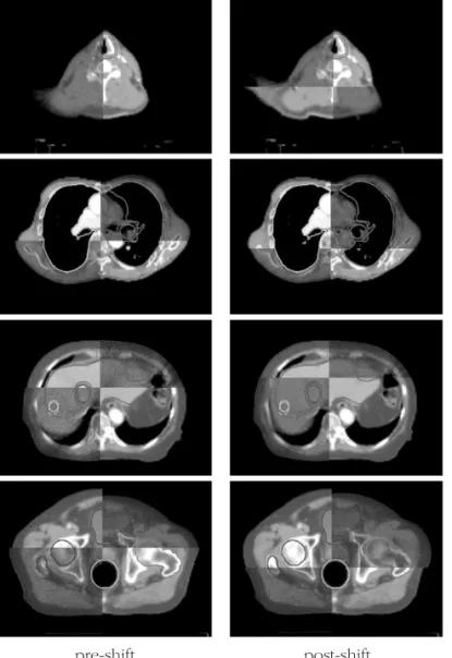 Fig 3. The example of megavoltage CT(MVCT) images on (a) pre-shift line and (b) post-shift line axial view