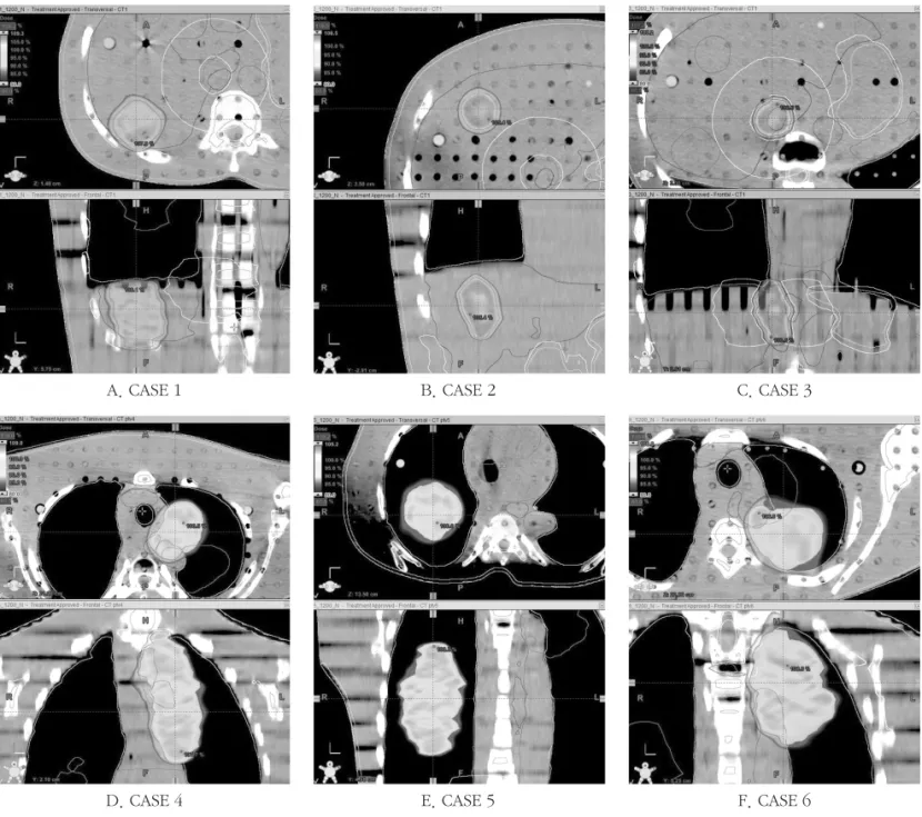 Fig 2. Treatment plan of each cases (A. CASE1, B. CASE2, C. CASE3, D. CASE4, E. CASE5, F
