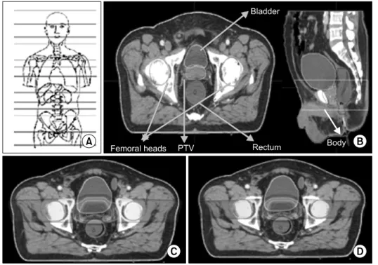 Fig. 2. (A) The CT sim site  remark for deciding the scan part. 