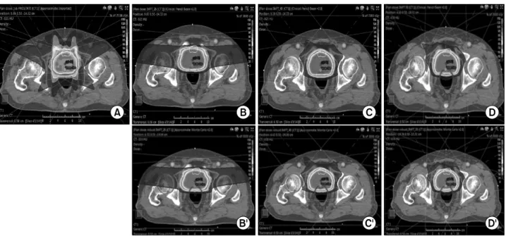 Fig. 2. Isodose distributions of prescription dose of 70 Gy to PTV for different treatment techniques
