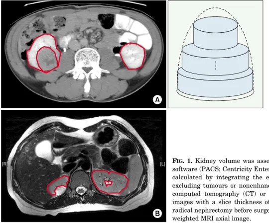 Table 3 shows the results of the univariate and multi- multi-variate binary regression analysis to identify the  pre-dictive factors for renal sufficiency (an eGFR less than 60  mL/min/1.73 m 2 ) 5 years after radical nephrectomy